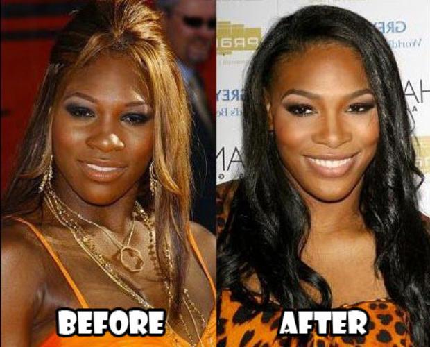 Serena-Williams-Plastic-Surgery-Before-After